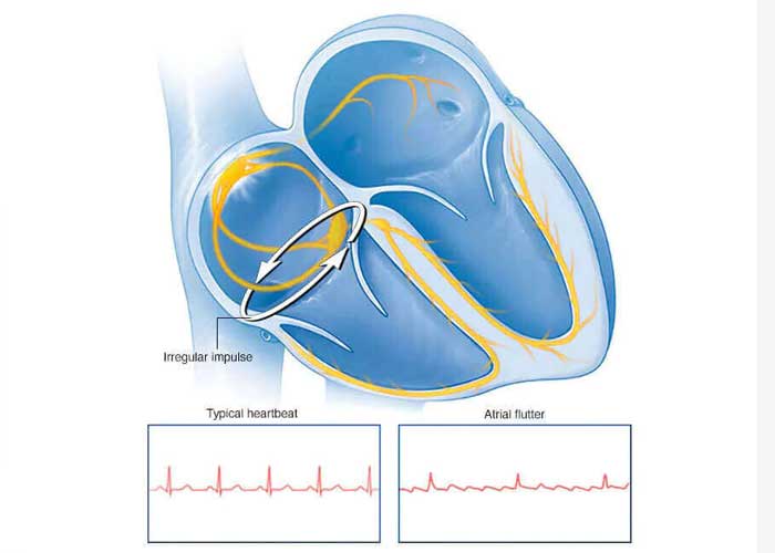 Best Atrial Flutter Treatment In Hyderabad