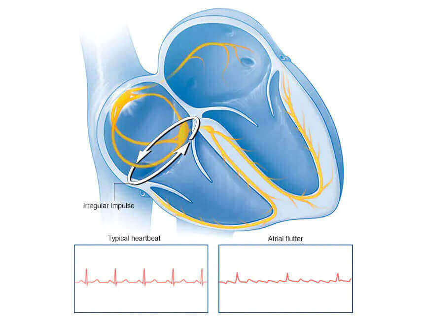 Best Atrial Flutter Treatment In Hyderabad | Dr.Sudheer