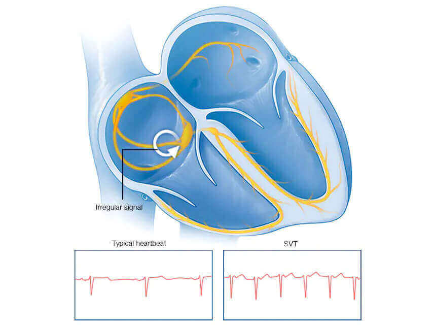 Supraventricular Tachycardia Treatment In Hyderabad 